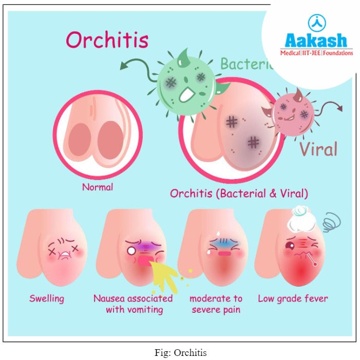 Orchitis