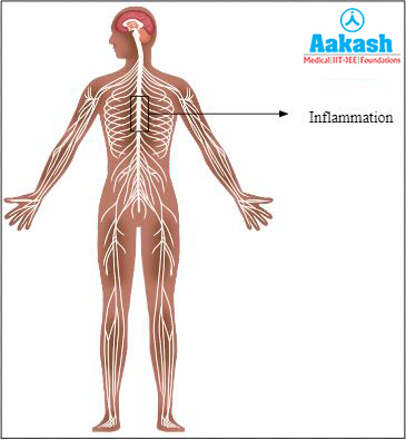 Acute transverse myelitis Diagram