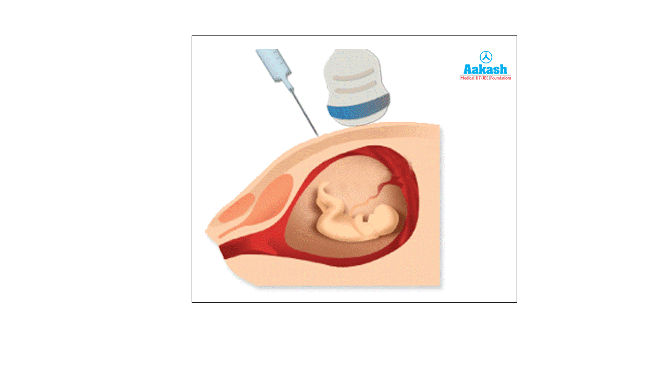 Amniocentesis Diagram