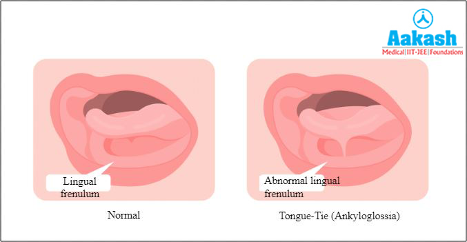 Ankyloglossia or tongue-tie Diagram