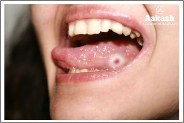 Canker sores Diagram