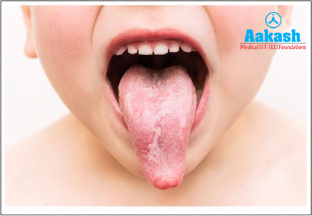 Geographic tongue Diagram