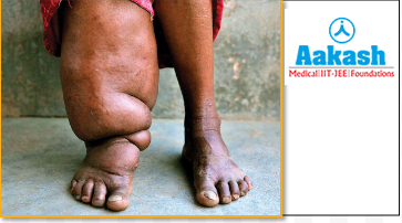 Lymphatic filariasis