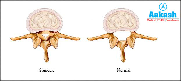 Spinal stenosis Diagram
