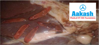 Infected human liver with liver fluke