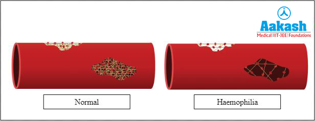 Clotting under normal and haemophilic conditions