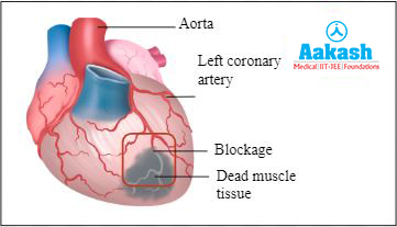 Myocardial infarction
