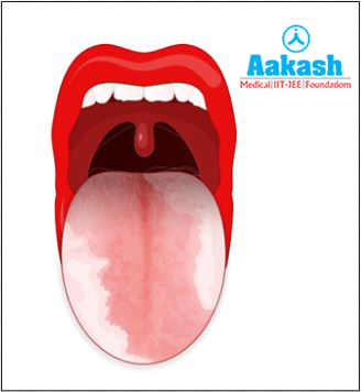 Oral leukoplakia Diagram