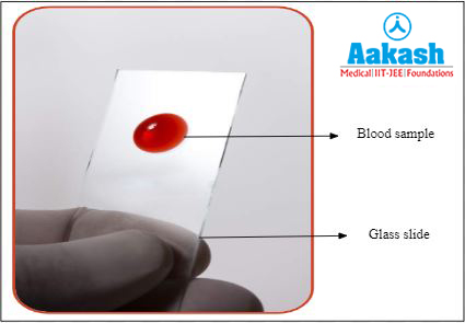 Blood smear test