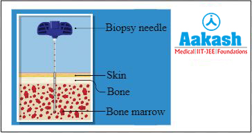 Bone marrow aspiration and biopsy