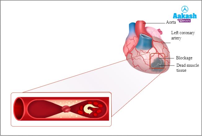 Underlying physiology during heart attack