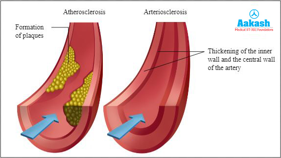 Narrowing of lumen of coronary arteries