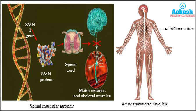 Common spinal cord disorders Diagram