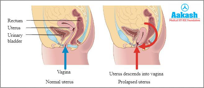 Uterus
