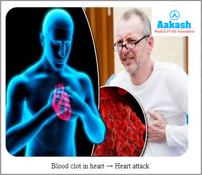 Common symptoms heart attack