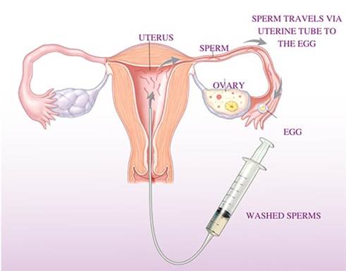 The process of IUI