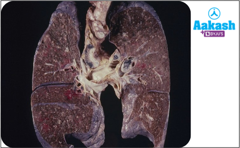 Fig: Condition of lungs in pulmonary tuberculosis