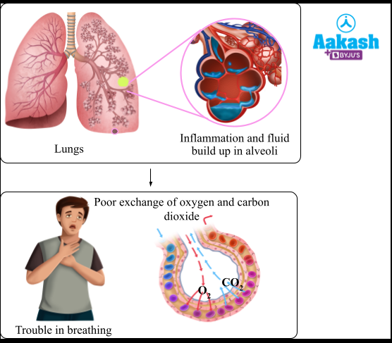 Mechanism of infection of pneumonia