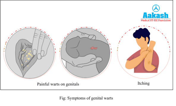 Symptoms of Genital Warts