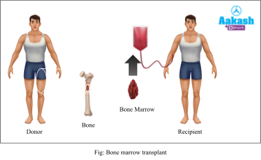  Bone marrow transplant