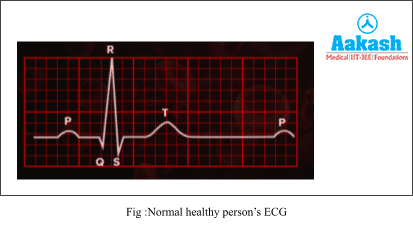 Normal healthy person’s ECG