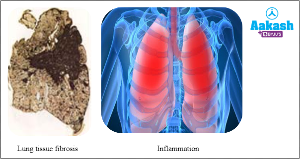 Fig: Common symptoms of occupational respiratory disorders
