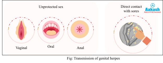 Transmission of Genital Herpes
