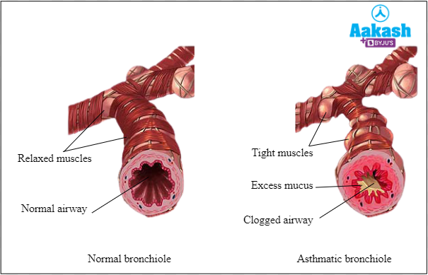 Fig: Causes of bronchial asthma