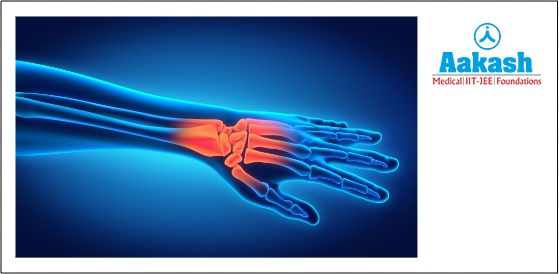Osteoarthritis in the hand and wrist joint