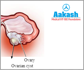 An ovarian cyst