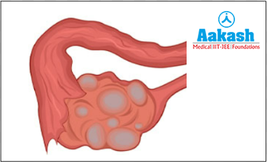 PCOS (Polycystic ovarian syndrome)