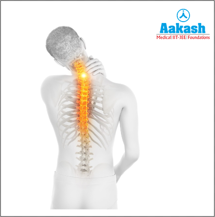 Osteoarthritis in the back and neck joint