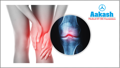 Osteoarthritis in the knee joint