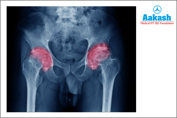 Osteoarthritis in the hip joint