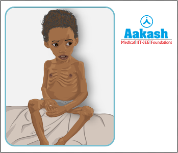 Common symptoms of marasmus