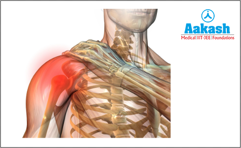 Osteoarthritis in the shoulder joint