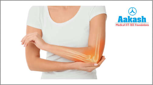 Osteoarthritis in the elbow joint