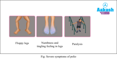 severe symptoms of polio