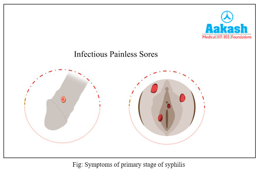 symptoms of primary stage of syphilis diagram